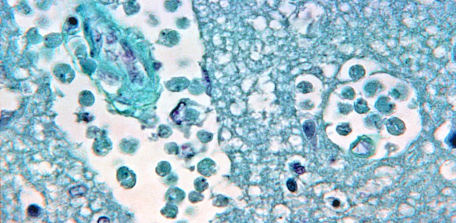 צילום מיקרוסקופי של ''אמבה אוכלת מוח'' / צילום: Reuters, CDC צילום מיקרוסקופי של ''אמבה אוכלת מוח'' / צילום: Reuters, CDC